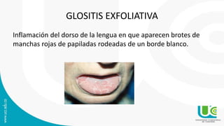 GLOSITIS EXFOLIATIVA
Inflamación del dorso de la lengua en que aparecen brotes de
manchas rojas de papiladas rodeadas de un borde blanco.
 