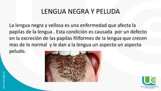 LENGUA NEGRA Y PELUDA
La lengua negra y vellosa es una enfermedad que afecta la
papilas de la lengua . Esta condición es causada por un defecto
en la excreción de las papilas filiformes de la lengua que crecen
mas de lo normal y le dan a la lengua un aspecto un aspecto
peludo.
 