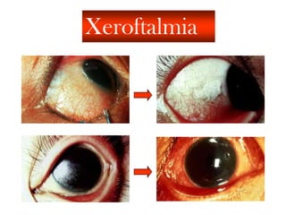 Xeroftalmia
 