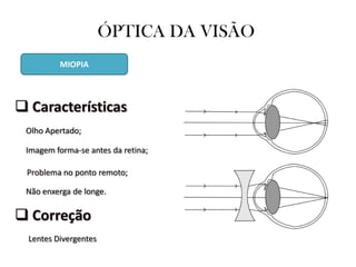 ÓPTICA DA VISÃO
Olho Apertado;
Imagem forma-se antes da retina;
Problema no ponto remoto;
 Características
 Correção
Lentes Divergentes
Não enxerga de longe.
MIOPIA
 
