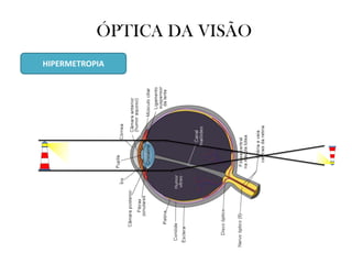 ÓPTICA DA VISÃO
HIPERMETROPIA
 