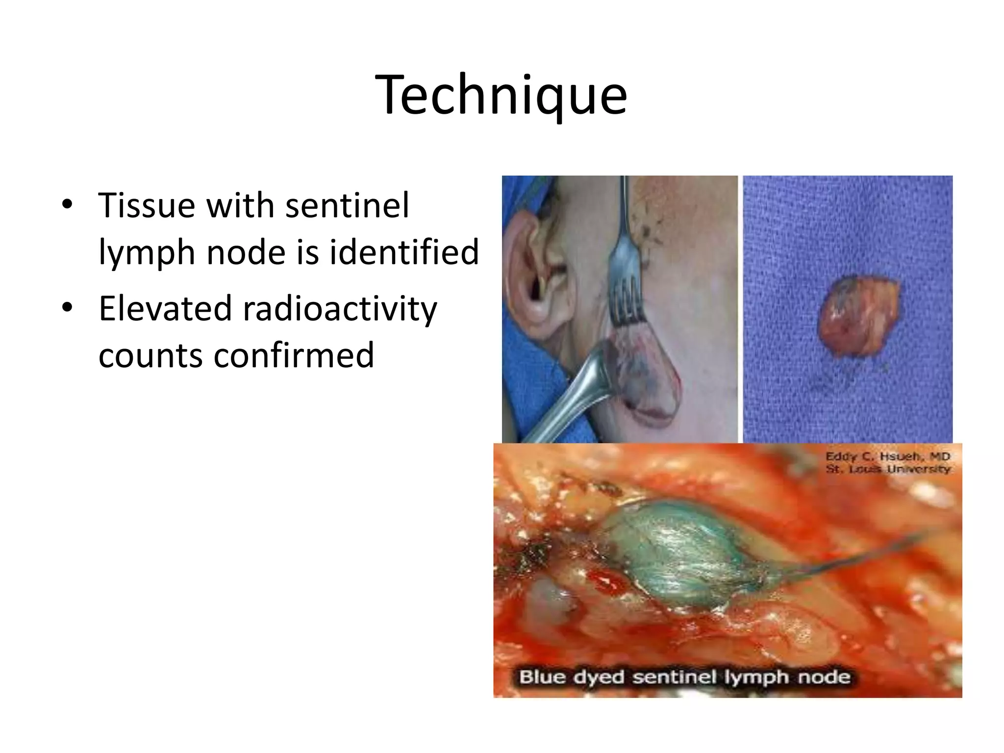 Technique
• Tissue with sentinel
lymph node is identified
• Elevated radioactivity
counts confirmed
 