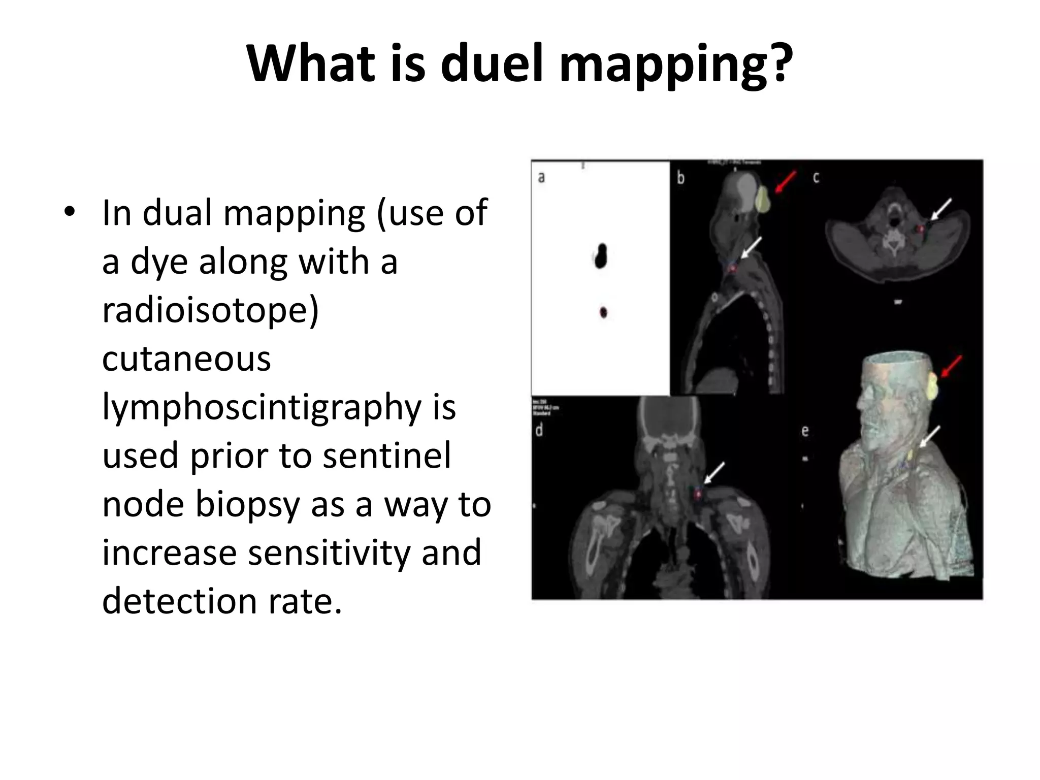 What is duel mapping?
• In dual mapping (use of
a dye along with a
radioisotope)
cutaneous
lymphoscintigraphy is
used prior to sentinel
node biopsy as a way to
increase sensitivity and
detection rate.
 