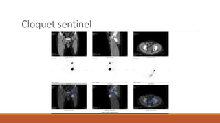 Sentinel node biopsy in oncology a breif overview | PPTX