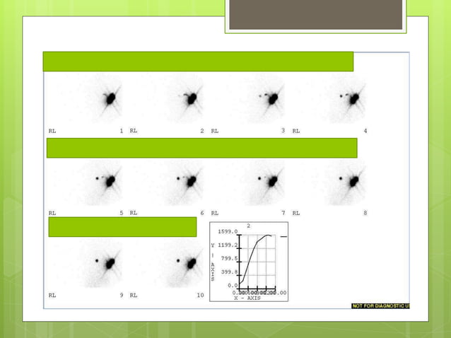 Sentinel node mapping in breast cancer controversies | PPTX | Skin and ...