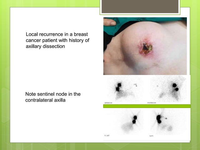 Sentinel node mapping in breast cancer controversies | PPTX | Skin and ...