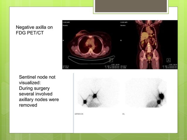 Sentinel node mapping in breast cancer controversies | PPTX | Skin and ...
