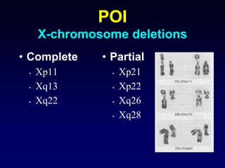POI
X-chromosome deletions
• Complete
• Xp11
• Xq13
• Xq22
• Partial
• Xp21
• Xp22
• Xq26
• Xq28
 
