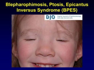 Blepharophimosis, Ptosis, Epicantus
Inversus Syndrome (BPES)
 