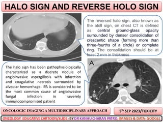 5th SEP 2023/TOXICITY
HALO SIGN AND REVERSE HOLO SIGN
ONCOLOGIC IMAGING A MULTIDISCIPLINARYAPPROACH
The reversed halo sign, also known as
the atoll sign, on chest CT is defined
as central ground-glass opacity
surrounded by denser consolidation of
crescentic shape (forming more than
three-fourths of a circle) or complete
ring. The consolidation should be at
least 2 mm in thickness
The halo sign has been pathophysiologically
characterized as a discrete nodule of
angioinvasive aspergillosis with infarction
and coagulative necrosis surrounded by
alveolar hemorrhage. IPA is considered to be
the most common cause of angioinvasive
fungal infection in severely
immunocompromised patient
 