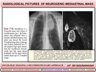 14th SEP 2023/RADIOLOGY
RADIOLOGICAL PICTURES OF NEUROGENIC MEDIASTINAL MASS
ONCOLOGIC IMAGING A MULTIDISCIPLINARYAPPROACH
 