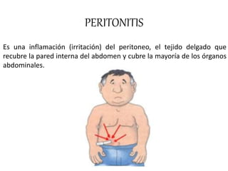 PERITONITIS
Es una inflamación (irritación) del peritoneo, el tejido delgado que
recubre la pared interna del abdomen y cubre la mayoría de los órganos
abdominales.
 