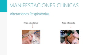 Tiraje subesternal
Alteraciones Respiratorias.
Tiraje intercostal
MANIFESTACIONES CLINICAS
 