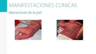 Alteraciones de la piel
MANIFESTACIONES CLINICAS
 