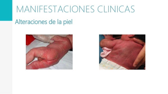 SEPSIS NEONATAL.