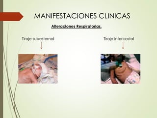 MANIFESTACIONES CLINICAS
Tiraje subesternal
Alteraciones Respiratorias.
Tiraje intercostal
 