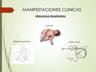 MANIFESTACIONES CLINICAS
Alteraciones Respiratorias.
cianosis
Quejido espiratorio Aleteo nasal
 