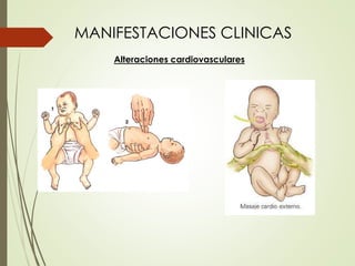 MANIFESTACIONES CLINICAS
Alteraciones cardiovasculares
 