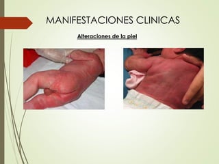 MANIFESTACIONES CLINICAS
Alteraciones de la piel
 