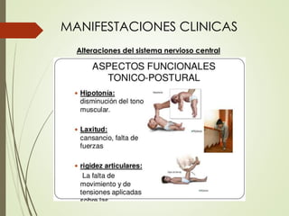 MANIFESTACIONES CLINICAS
Alteraciones del sistema nervioso central
 