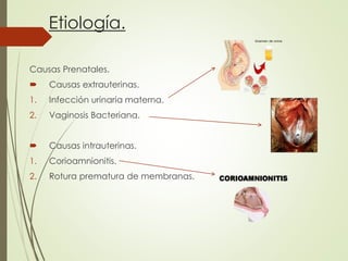 Etiología.
Causas Prenatales.
 Causas extrauterinas.
1. Infección urinaria materna.
2. Vaginosis Bacteriana.
 Causas intrauterinas.
1. Corioamnionitis.
2. Rotura prematura de membranas.
 