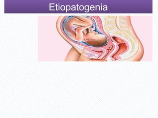 EtiopatogeniaEtiopatogenia
 