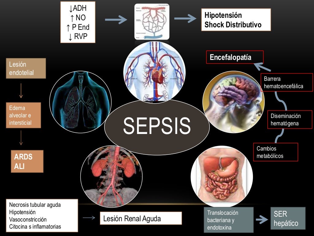 Sepsis severa y shock septico