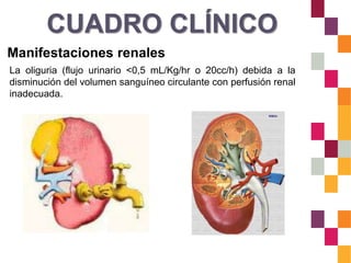 CUADRO CLÍNICO
Manifestaciones renales
La oliguria (flujo urinario <0,5 mL/Kg/hr o 20cc/h) debida a la
disminución del volumen sanguíneo circulante con perfusión renal
inadecuada.
 
