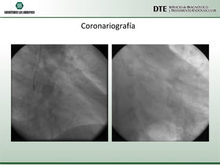Coronariografía 