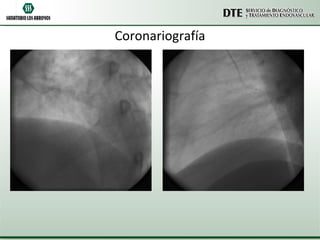 Coronariografía 