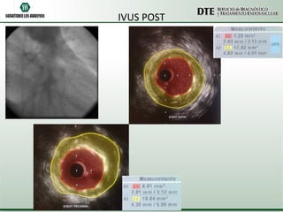 IVUS POST 