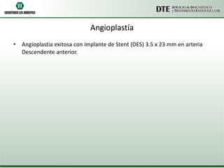 Angioplastía Angioplastia exitosa con implante de Stent (DES) 3.5 x 23 mm en arteria Descendente anterior. 