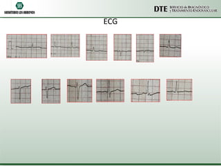 ECG 
