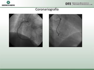 Coronariografía 