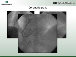 Coronariografía 