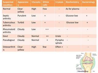Suspected      Appearanc   Viscosity White     Crystals   Biochemistry    Bacteriology
condition      e                     cells
Normal         Clear       High     Few           -       As for plasma      -
               yellow
Septic         Purulent    Low        +           -       Glucose low        +
arthritis
Tuberculous    Turbid      Low        +           -       Glucose low         +
arthritis
Rheumatoid     Cloudy      Low         ++         -        -                     -
arthritis
Gout           Cloudy      Normal         ++   Urate       -                     -
Pseudogout     Cloudy      Normal         +    Pyropho     -                     -
                                               sphate
Osteoarthrit   Clear       High     few        Often +     -                     -
is             yellow
 