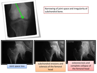 Narrowing of joint space and irregularity of
                         subchondral bone.




                   subchondral erosions and         osteonecrosis and
Joint space loss    sclerosis of the femoral       complete collapse of
                              head                   the femoral head
 