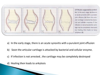 a) In the early stage, there is an acute synovitis with a purulent joint effusion
b) Soon the articular cartilage is attacked by bacterial and cellular enzyme.
c) If infection is not arrested , the cartilage may be completely destroyed
d) Healing then leads to ankylosis
 