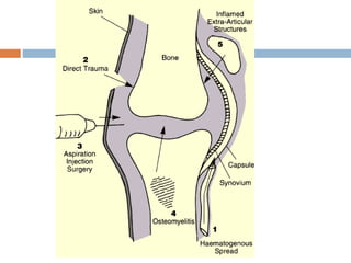 Septic arthritis | PPTX