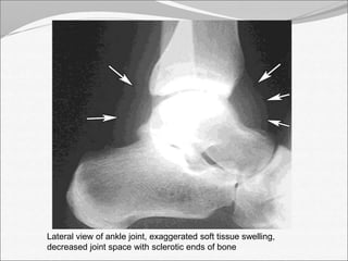 Lateral view of ankle joint, exaggerated soft tissue swelling, 
decreased joint space with sclerotic ends of bone 
 