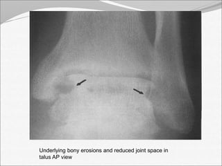 Underlying bony erosions and reduced joint space in 
talus AP view 
 