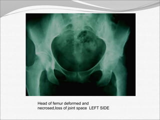 Head of femur deformed and 
necrosed,loss of joint space LEFT SIDE 
 