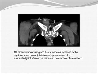 CT Scan demonstrating soft tissue oedema localised to the 
right sternoclavicular joint (A) and appearances of an 
associated joint effusion, erosion and destruction of sternal end 
 