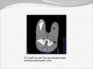 CT of left hip joint The dd included septic 
arthritis/osteomyelitis joint 
 