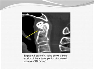 Sagittal CT scan of C-spine shows a bone 
erosion of the anterior portion of odontoid 
process of C2 (arrow) 
 