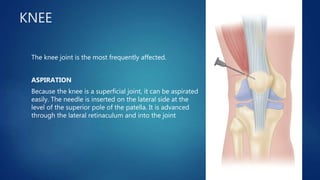 KNEE
The knee joint is the most frequently affected.
ASPIRATION
Because the knee is a superficial joint, it can be aspirated
easily. The needle is inserted on the lateral side at the
level of the superior pole of the patella. It is advanced
through the lateral retinaculum and into the joint
 