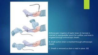 Arthroscopic irrigation of septic knee. A, Cannula is
inserted in suprapatellar pouch for outflow, and knee is
irrigated through arthroscopic sheath.
B, Small suction drain is inserted through arthroscopic
sheath.
C, Sheath is removed as drain is held in place. SEE
 