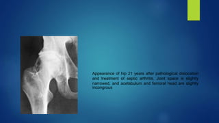 Appearance of hip 21 years after pathological dislocation
and treatment of septic arthritis. Joint space is slightly
narrowed, and acetabulum and femoral head are slightly
incongrous
 