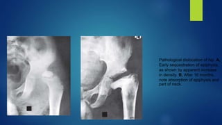 Pathological dislocation of hip. A,
Early sequestration of epiphysis,
as shown by apparent increase
in density. B, After 16 months,
note absorption of epiphysis and
part of neck.
 