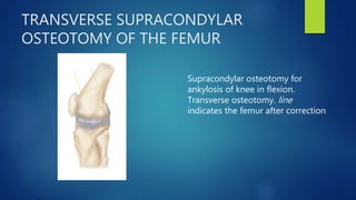 TRANSVERSE SUPRACONDYLAR
OSTEOTOMY OF THE FEMUR
Supracondylar osteotomy for
ankylosis of knee in flexion.
Transverse osteotomy. line
indicates the femur after correction
 